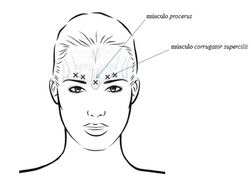Schematic drawing of a female face showing injection points for the procerus muscle and the corrugator supercilii muscle