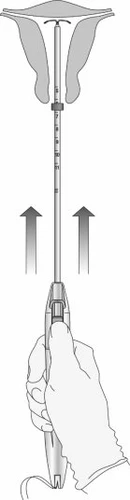 Medical diagram showing a gloved hand pushing an applicator toward the