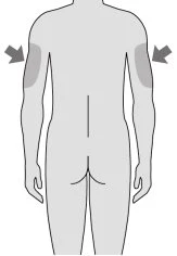 Diagramma del corpo umano visto di schiena con frecce grigie che indicano zone di iniezione