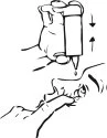 Disegno tecnico che mostra una mano che tiene un dispositivo medico sopra la pelle e un'