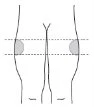 Schema stilizzato del corpo umano che indica con due aree grigie e linee tratteggiate orizzontali le zone di applicazione del farmaco sulle cosce