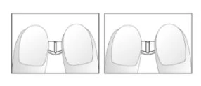 Two schematic diagrams showing two fingers pressing together a small device or component between them