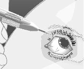 Illustrazione medica di una siringa con ago che si avvicina all'