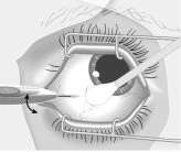 Disegno medico che mostra un occhio aperto con divaricatori metallici e uno strumento chirurgico che tocca la superficie oculare