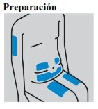 Medical diagram showing a human torso with four blue rectangular areas positioned on the arm and on