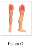 Diagramma di due gambe umane viste di profilo con aree rettangolari rosse applicate sulla parte superiore della coscia per indicare la zona di somministrazione