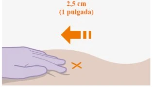 Medical illustration with an orange arrow and the text '2.5 cm' indicating the distance from an 'X' mark on the skin near a gloved hand