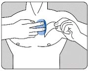Schematic drawing of a male torso with two hands applying a blue patch on the chest and lifting a skin flap for
