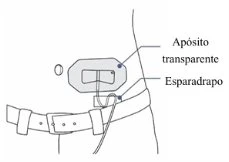 Schema medico che mostra una medicazione con cerotto trasparente e nastro adesivo applicato sopra una cintura sulla vita di una persona