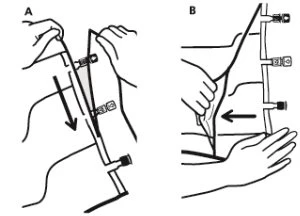 Two-stage medical diagram showing hands manipulating a medical device with black arrows indicating insertion and withdrawal movements