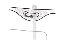Medical diagram showing a ring-shaped device inserted beneath a dotted tissue layer with a vertical reference line