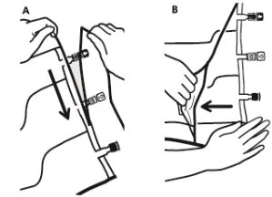 Diagramma medico in due parti che mostra le mani che manovrano un dispositivo medico con frecce nere che indicano la direzione del movimento