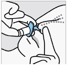Mani che impugnano un dispositivo medico blu e bianco per applicarlo sulla pelle del corpo vicino a una serie di piccoli punti grigi