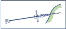 Diagramma tecnico che mostra l'assemblaggio di un dispositivo medico