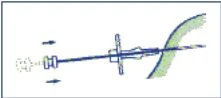 Diagramma tecnico che mostra il funzionamento di un dispositivo medico
