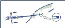 Diagramma medico che mostra l'anatomia interna di un dispositivo terapeutico