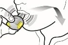 Schematic drawing of a person biting down and opening a medical device, with a downward movement indicated by a gray arrow