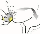 Technical drawing showing a hand pressing a medical device against the skin with an arrow indicating downward movement