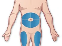 Diagram of the male torso with circular blue areas on the abdomen indicating injection sites