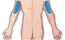 Medical illustration of the back torso and arms of a person, with two oval blue areas positioned on the deltoid muscles