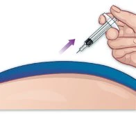 A hand holding a syringe at an angle and the tip of the needle entering the skin of the abdomen