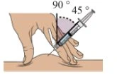 Illustrazione medica che mostra una mano che tiene una siringa per un'iniezione sottocutanea