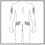 Schematic drawing of the human body viewed from the back with four gray areas indicating injection sites on the arms and hips