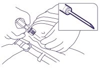 Disegno tecnico che mostra due mani che preparano un dispositivo medico su un corpo, con un ingrandimento dell'ago in primo piano