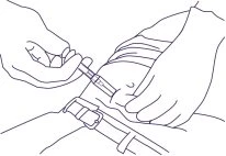 Due mani tengono una siringa per iniettare il contenuto nel tessuto adiposo dell'addome sopra una cintura elastica