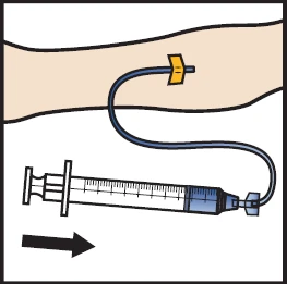 Syringe with a flexible tube connected to a device inserted into an arm, with a black arrow indicating the direction of movement