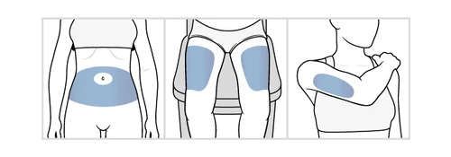 Tres diagramas que muestran los sitios de aplicación del medicamento en el cuerpo