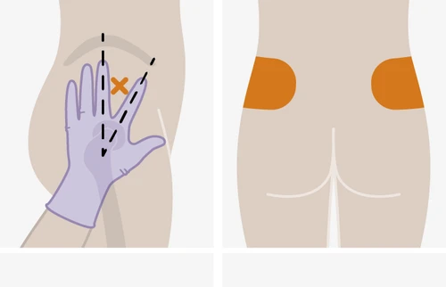 Diagrama médico que muestra una mano enguantada que indica la zona correcta para la