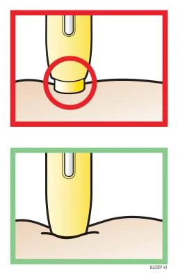 Diagrama médico con dos recuadros: el superior con borde rojo muestra un dispositivo amarillo colocado sobre la piel; el inferior con borde verde muestra el mismo dispositivo presionado sobre la piel
