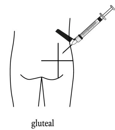 Esquema médico que muestra una jeringa con aguja insertada en un músculo glúteo con un ángulo de 90 grados respecto a la superficie cutánea