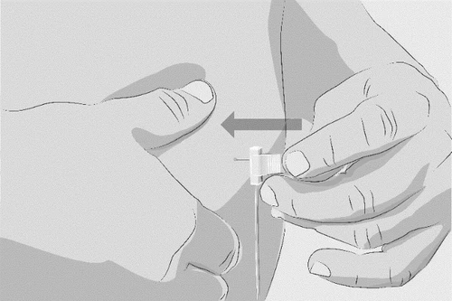 Dos manos manipulan un dispositivo médico subcutáneo en un abdomen, con una flecha que indica el movimiento de inserción hacia la piel