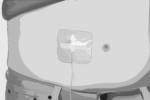 Dibujo estilizado de un dispositivo médico aplicado sobre la piel del...