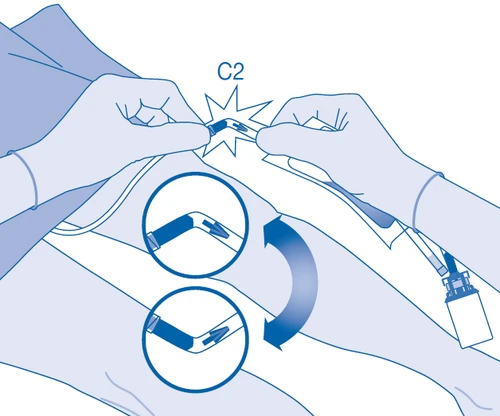 Two gloved hands manipulating a medical device marked C2 with two circles showing the bending movement of the component
