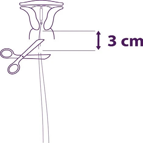 Medical diagram showing a pair of scissors cutting a small tube 3 cm from the base of a purple medical device on a white background
