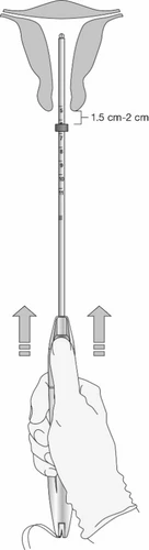 Medical diagram showing a thin device inserted into the
