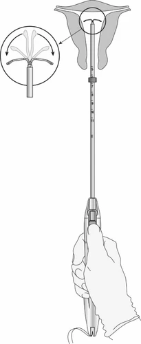 Medical diagram showing a gloved hand holding a device for the