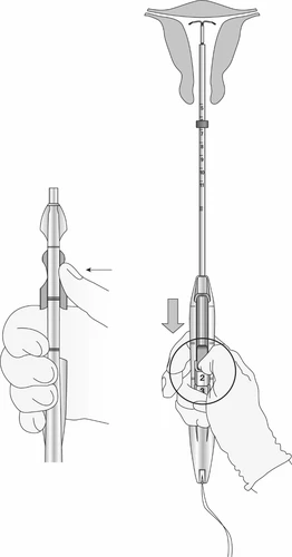 Technical drawing showing two hands holding a syringe-shaped medical device with arrows indicating pressing motion