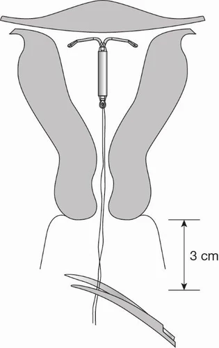 Medical diagram showing an intrauterine device inserted into the