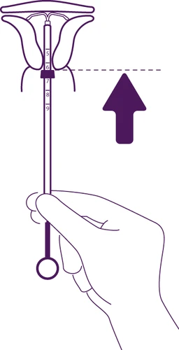 Medical diagram showing a hand pushing downward toward the