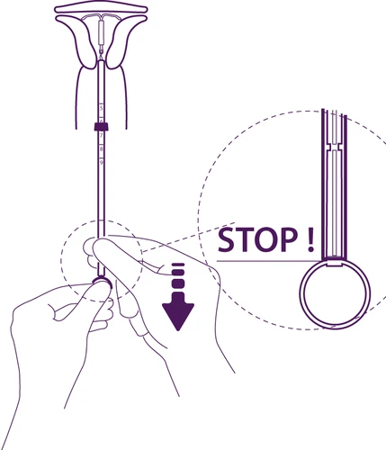 Purple technical drawing showing hands holding a medical device with an arrow pointing downward and a magnified inset labeled STOP