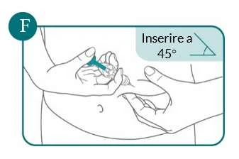 Diagrama que muestra dos manos insertando una aguja en el vientre del