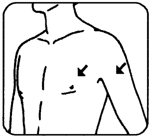 Dibujo esquemático del torso de un hombre con dos flechas negras que indican los puntos de inyección en el pecho y en la parte superior del brazo