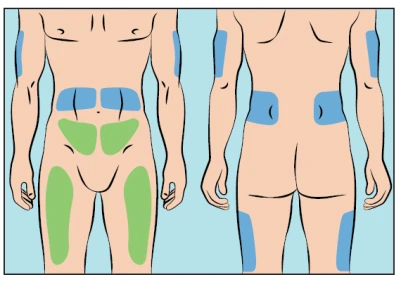 Diagrama del cuerpo humano que muestra áreas de inyección resaltadas en azul y verde en el abdomen, brazos, glúteos y muslos en vistas frontal y posterior