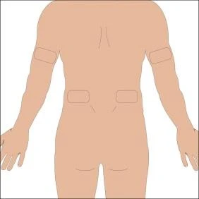 Diagram of the human body viewed from the back with four rectangular areas highlighted on the arms and lower back