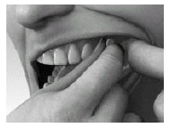 Black and white close-up of a person using their fingers to gently lift the upper lip to show the upper teeth