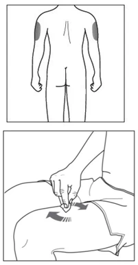 Dibujo esquemático de la espalda de un cuerpo humano con zonas resaltadas en los brazos y detalle de una mano que pellizca la piel del muslo